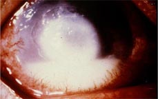 角膜潰瘍